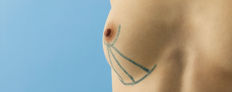 mamoplastia-aumento-4