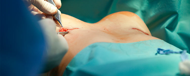 mamoplastia-aumento-5